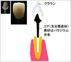 メタルコア